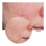 SOL X30 JUST AZELAIC 10% REVOX