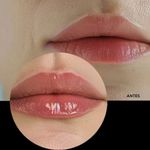 LIP FILLER x12 hialuronico B77 REVOX